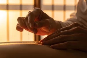 แพทย์แผนจีนกำลังทำการฝังเข็ม (Acupuncture)